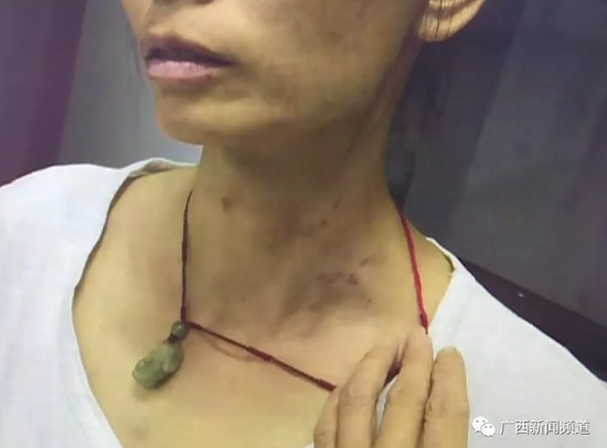 目前，王某已被警方依法刑事拘留，案件还在进一步措置惩罚惩罚中。